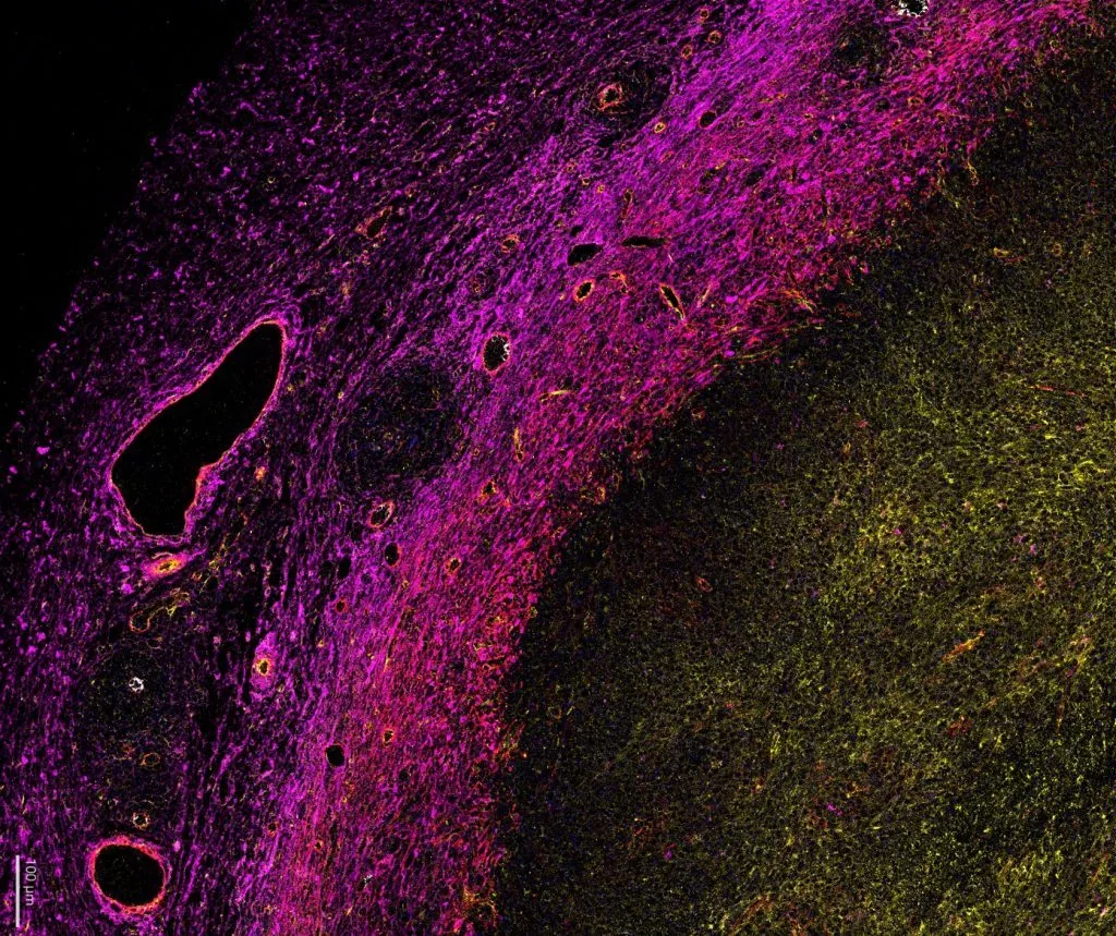 Multiplex immunofluorescence of a tumor section